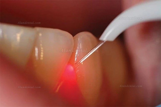 Gigaa Laser CHEESE Link Mini Dental Diode Laser 7W-10W 810/980nm